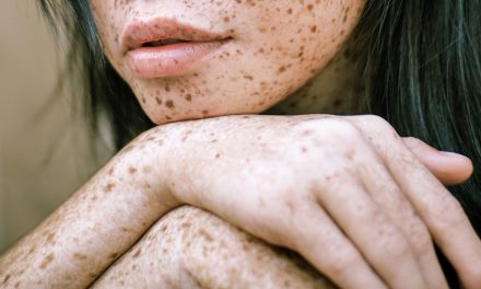 How to Treat Eczema naturally